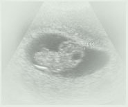 Ultrasound image of an 8-week old fetus